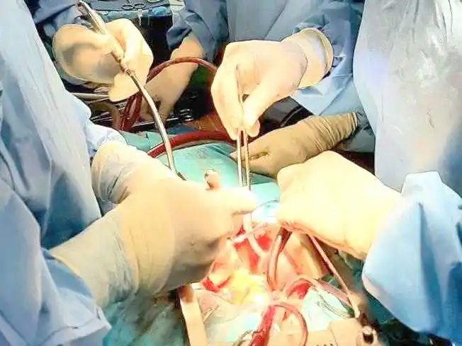 El HAC realizó reemplazo valvular mínimamente invasivo