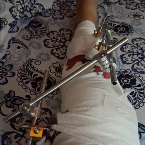 Una jubilada sufrió una grave fractura tras ser atacada por una jauría en San Lorenzo