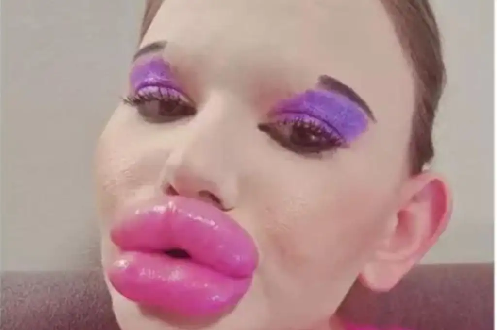 Pese al riesgo de muerte, la mujer con “los labios más gruesos del mundo” no parará con las inyecciones