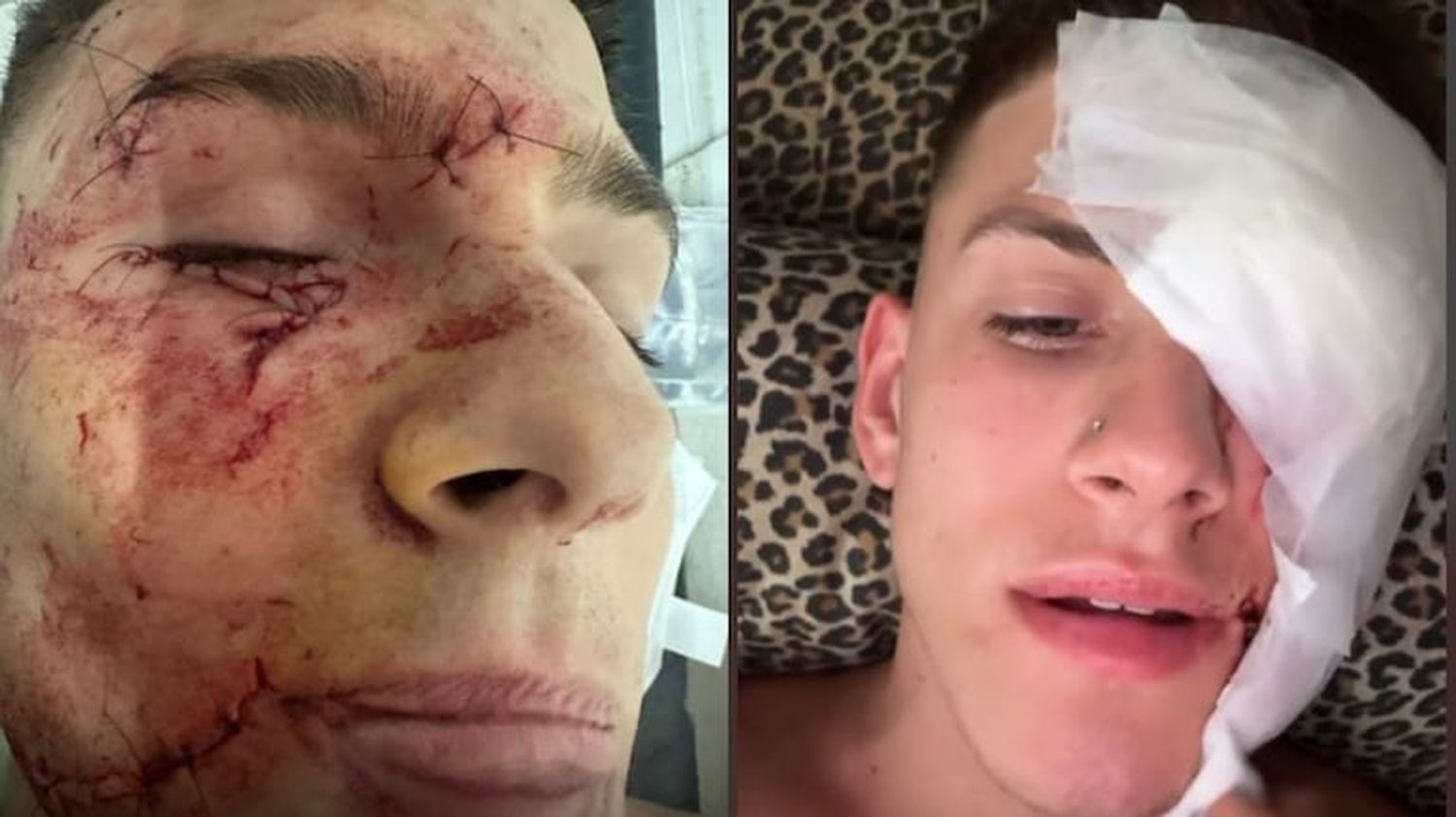 El brutal ataque a joven en Villa Gesell