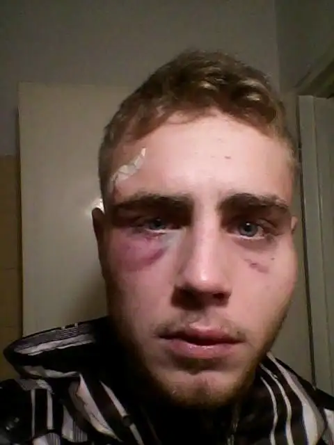 Denunció una feroz golpiza de patovicas en un boliche