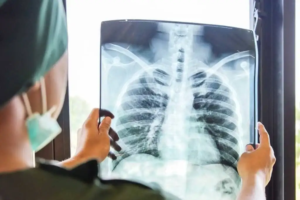 Alerta sanitaria en Entre Ríos: los casos de tuberculosis aumentaron casi un 39% en lo que va de 2026