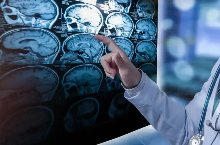 Día Mundial de la Esclerosis Múltiple: una enfermedad que se presenta entre los 20 y 40 años