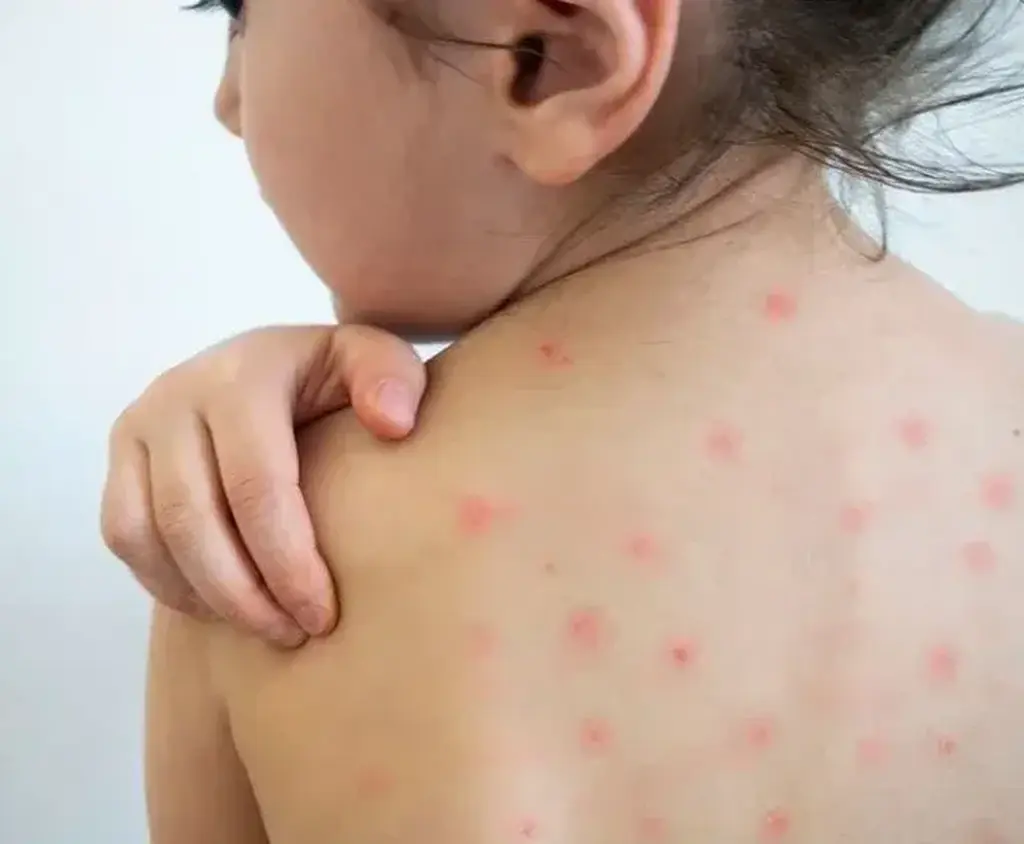 Suba de casos de sarampión.
