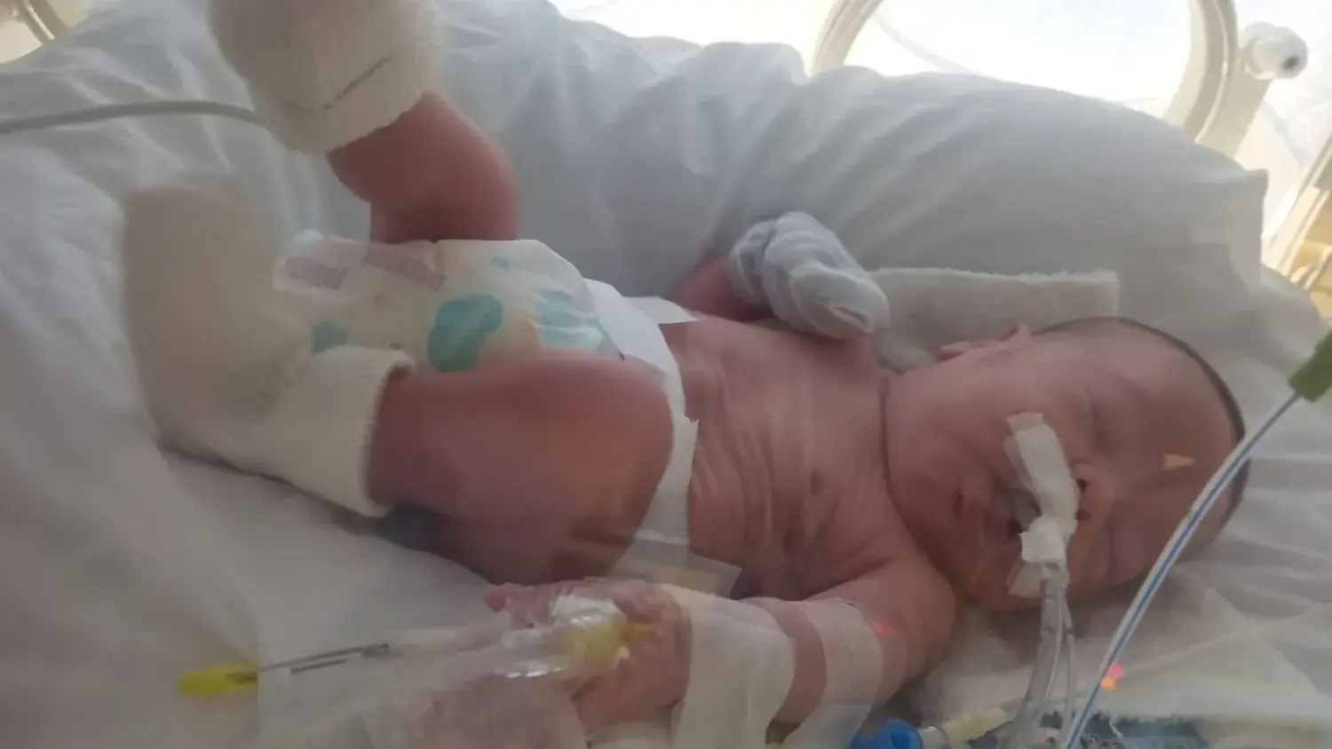 El pequeño sufrió una recaída con un sangrado en la cabeza, cuadro que obligó a extender su permanencia médica durante al menos dos semanas más