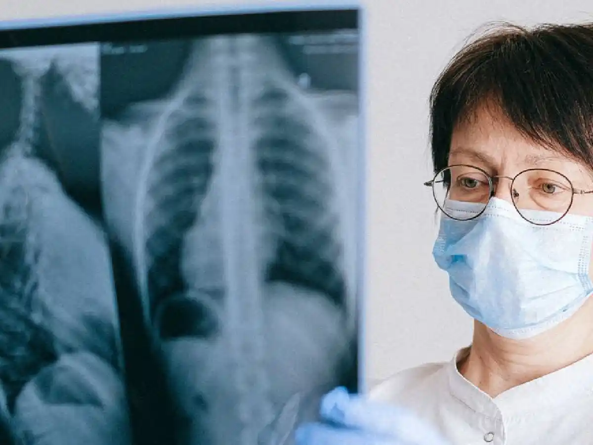 Qué es la mielitis transversa, la enfermedad por la cual se frenaron las pruebas de la vacuna de Oxford contra la COVID-19