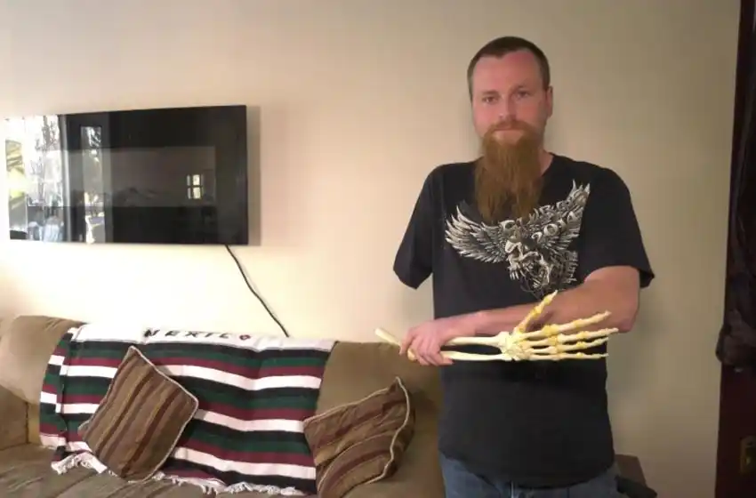 Le amputaron el brazo pero decidió quedarse con el esqueleto