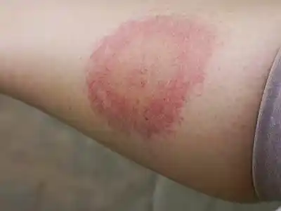 Cómo es el Lyme: la enfermedad provocada por una garrapata