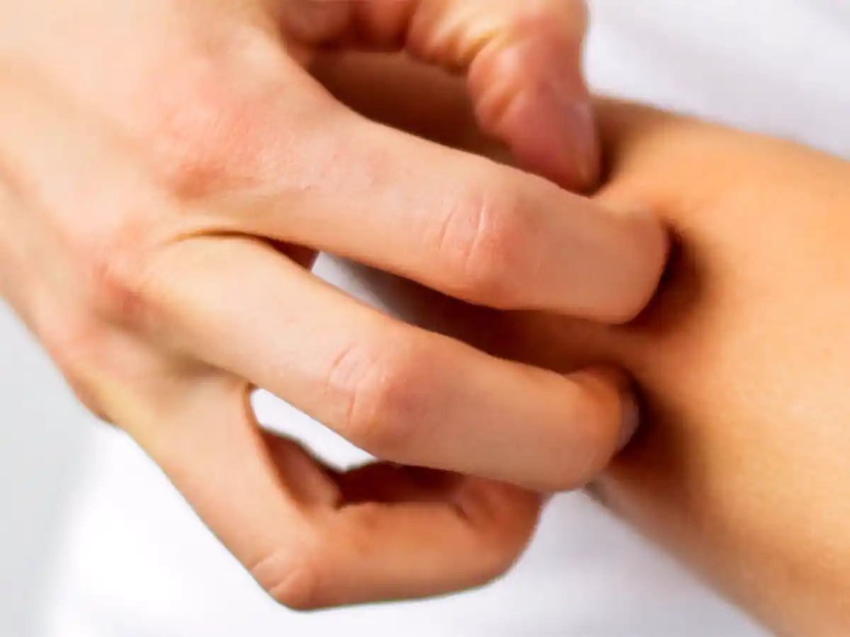 La urticaria afecta a un 20% de la población en algún momento de  su vida  