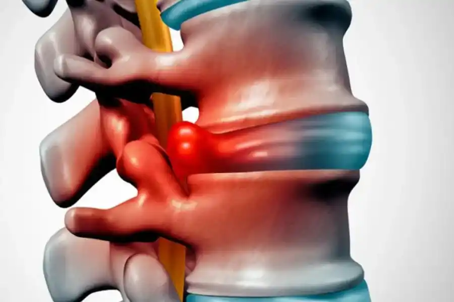 Qué es una hernia de disco lumbar y cuáles son sus síntomas