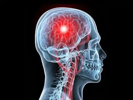 El neurocirujano Juan Baldovino habló sobre ACV