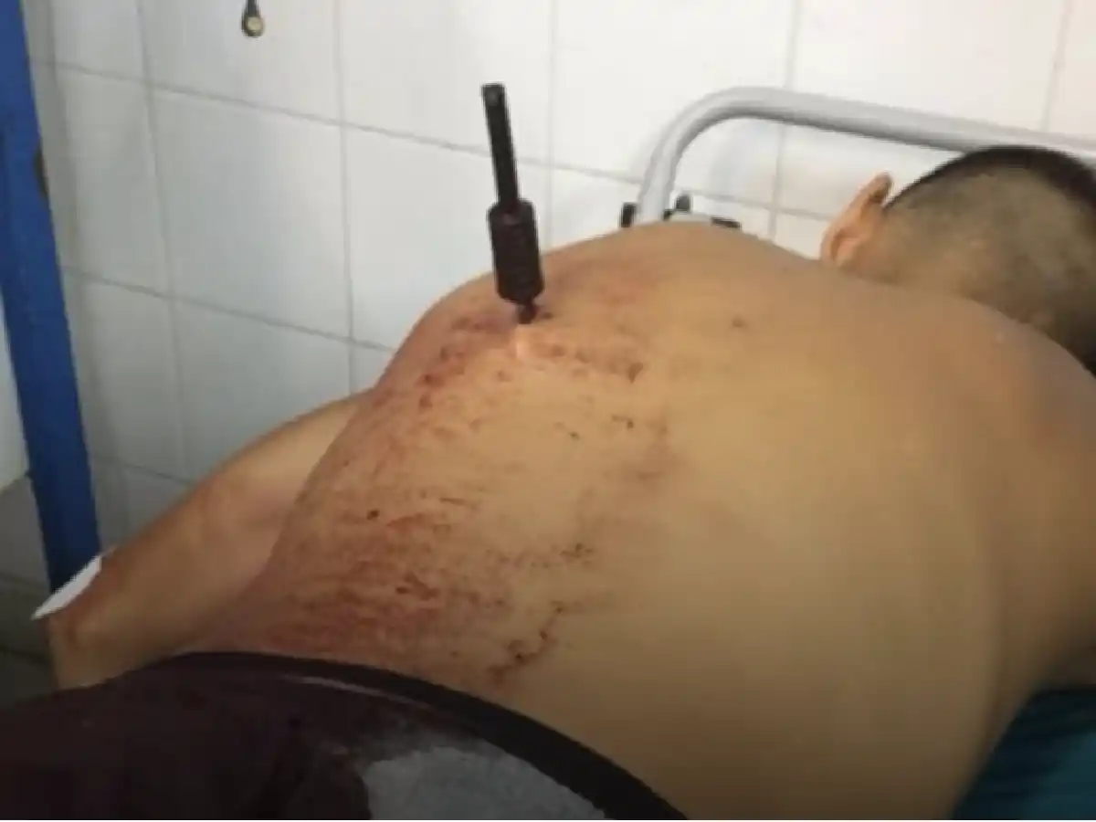 Córdoba: robó, una mujer lo apuñaló en la espalda y terminó internado