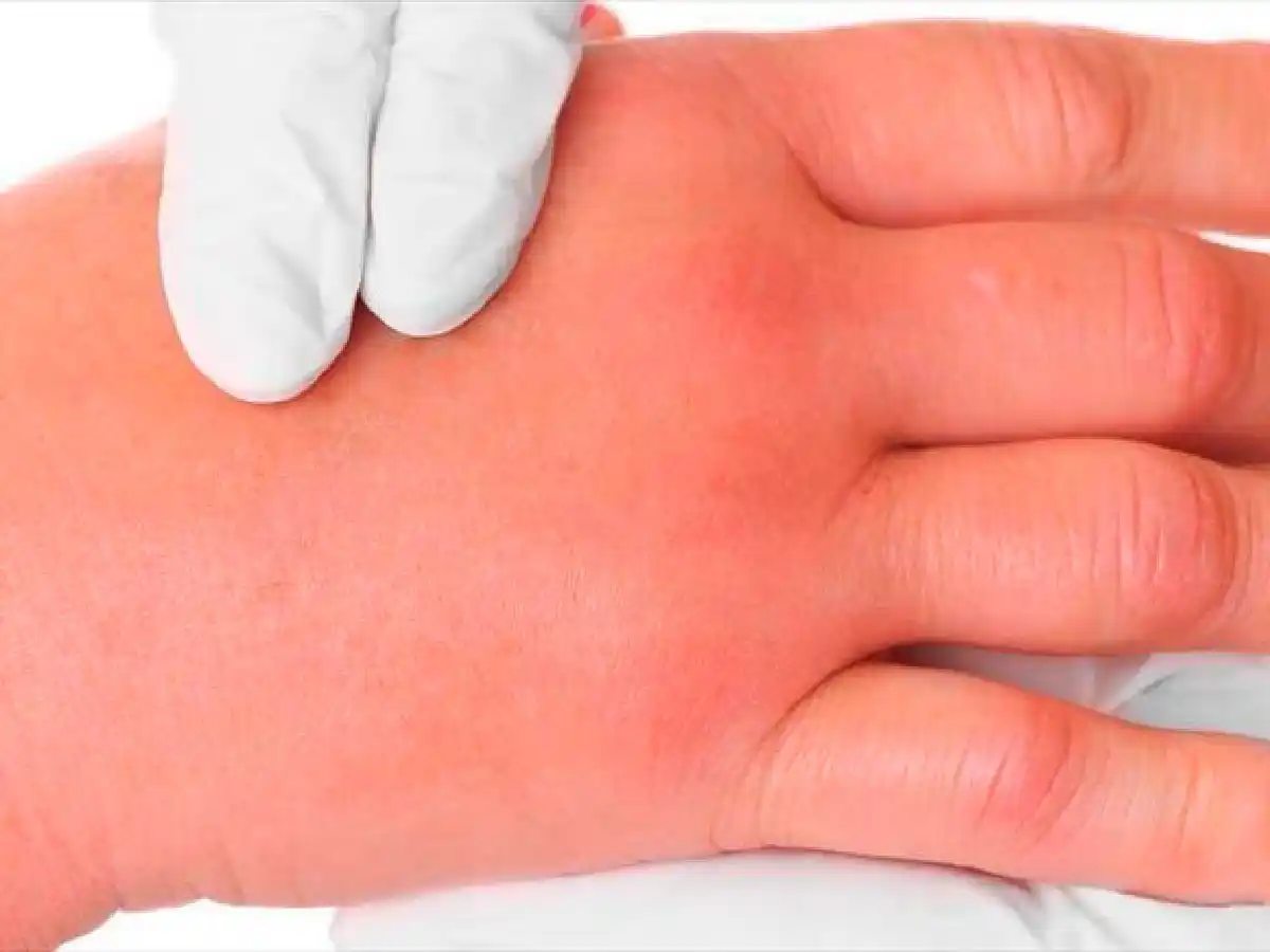 Una de cada 20 personas con angioedema muere por falta de tratamiento