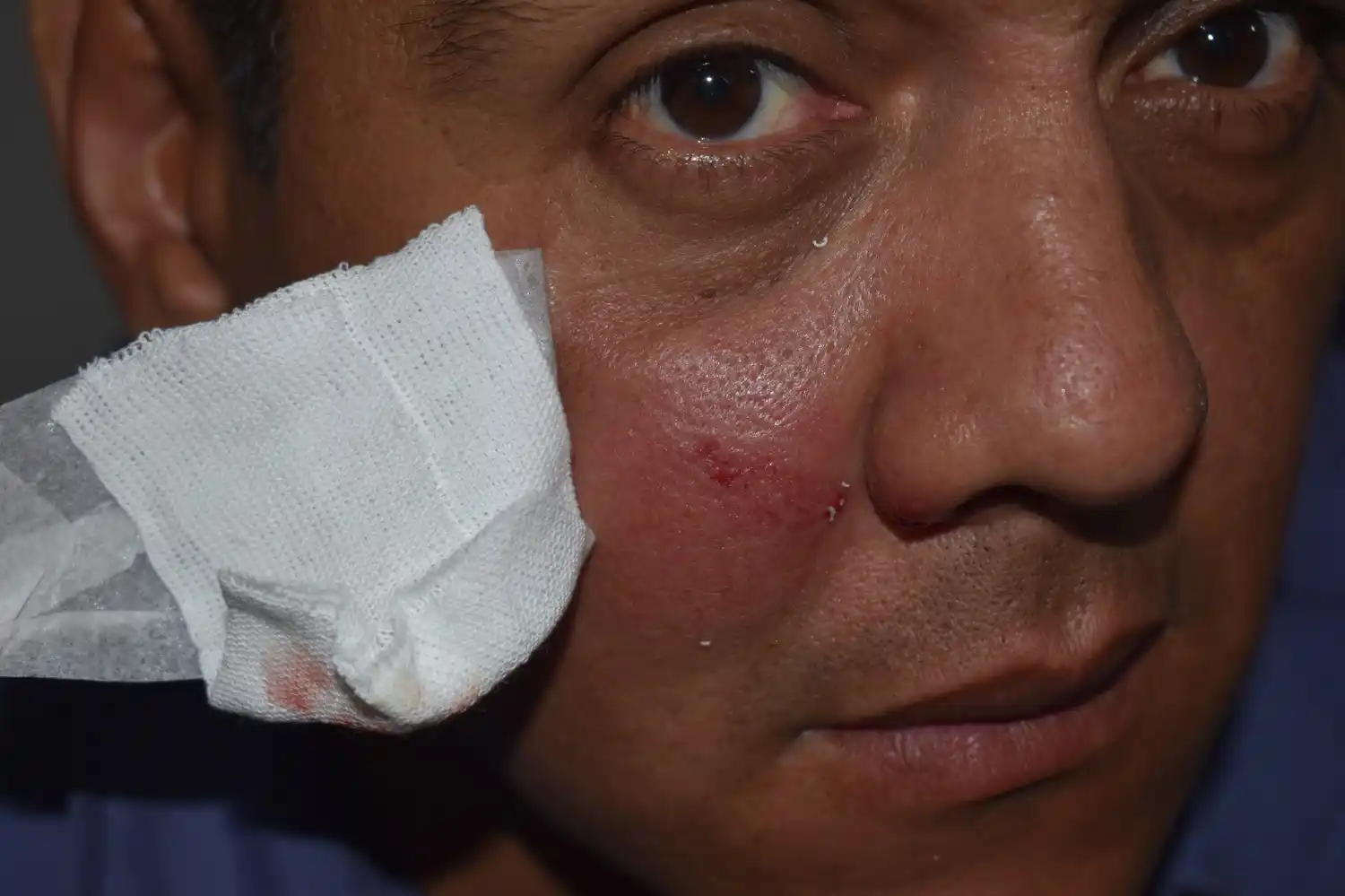 Con gomeras, jóvenes atacaron y lesionaron a un policía