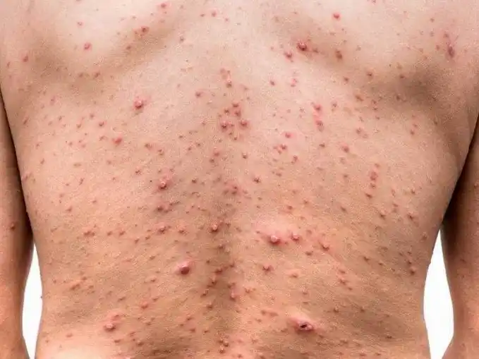 Desarrollo Humano lleva adelante acciones
ante aparición de casos compatibles con varicela