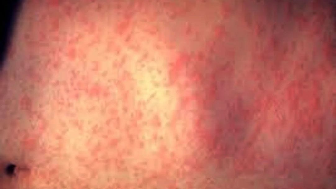Paraguay confirmó un caso importado de sarampión tras 10 años de eliminación del virus