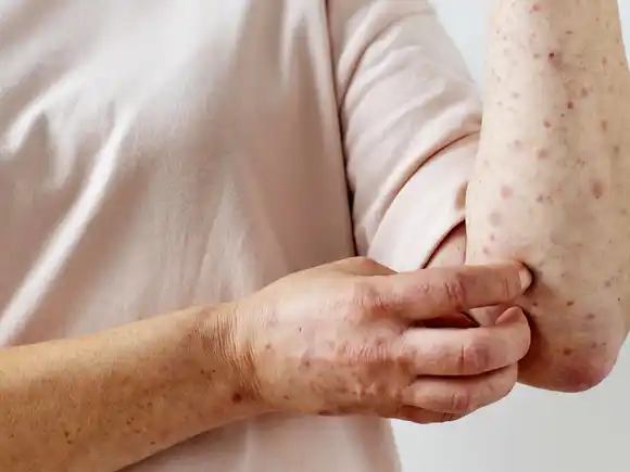 Salud realiza tareas de vigilancia ante probable caso de sarampión