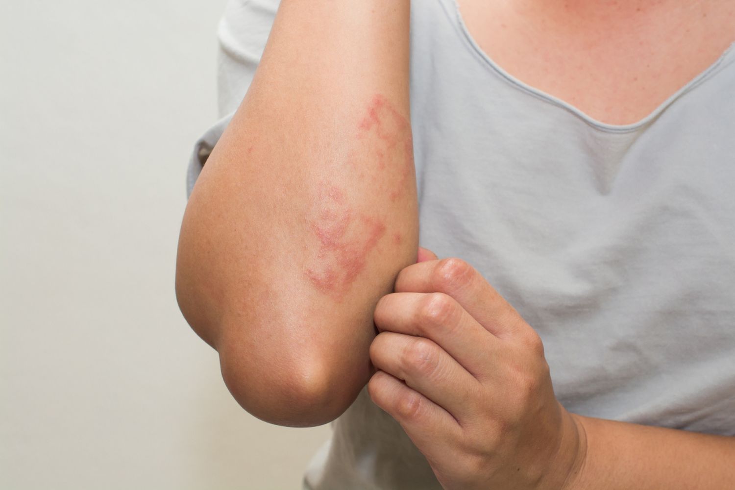 Dermatitis atópica.