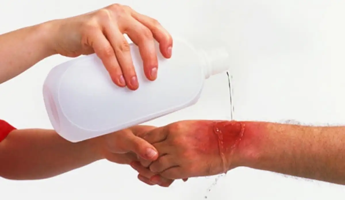La Facultad de Bromatología invita a un curso de atención de quemados