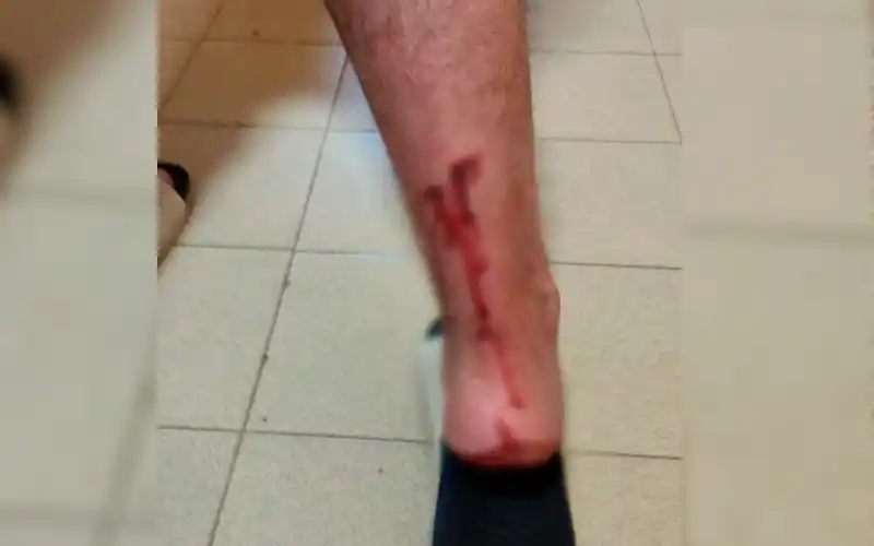 Perro mordió a un joven en un club: “No lo atendieron, ¿el que no tiene plata ni mutual qué hace?”