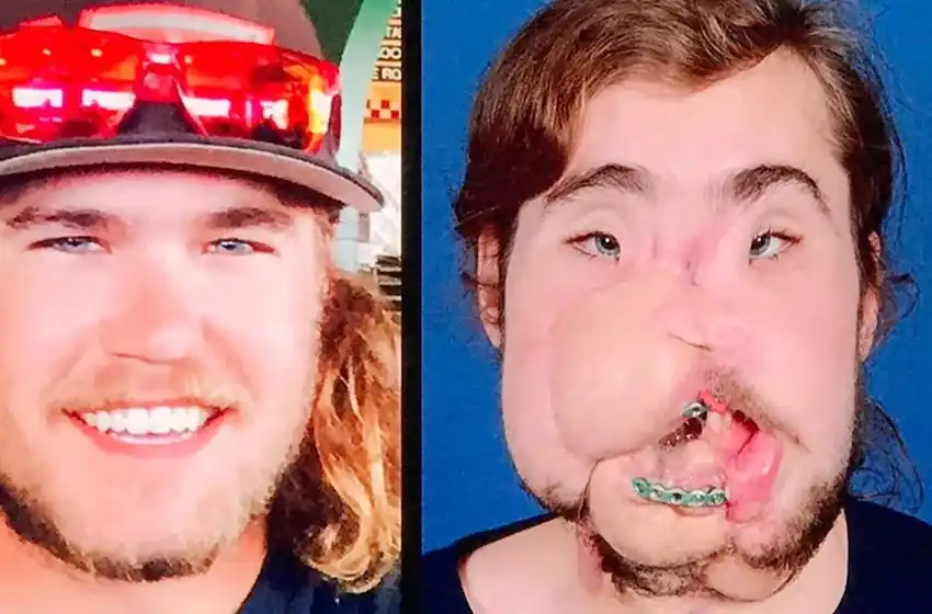 Se quiso suicidar, se destrozó el rostro y luego se sometió a una impresionante operación de cara