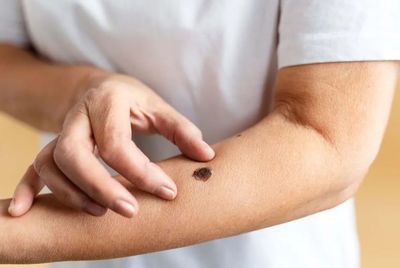 Alarma por el aumento de consultas por cáncer de piel y lesiones premalignas en la ciudad