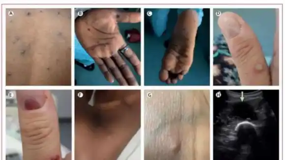 “No es de alarmarse” dice la OMS: en aumento casos de la viruela del mono en el mundo