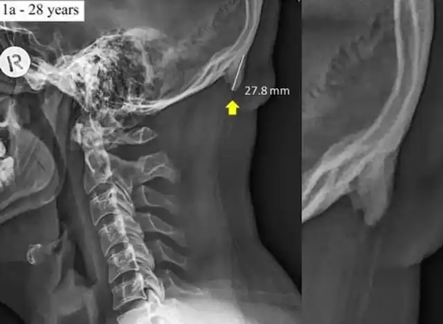 El uso del celular modificó el esqueleto humano
