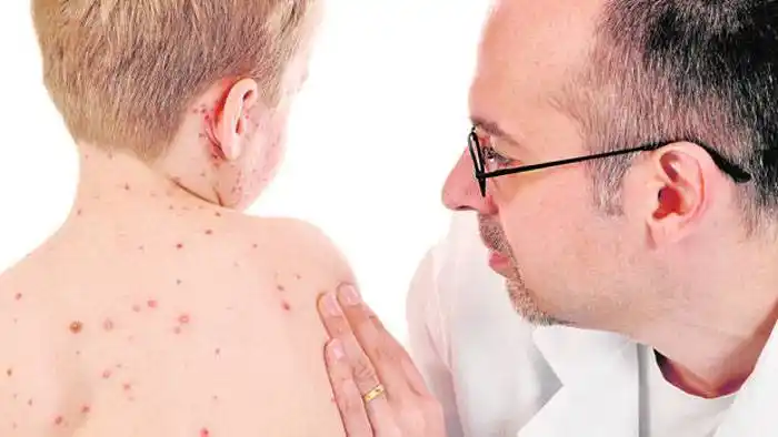 Más sarampión en el mundo, otro efecto de la pandemia de coronavirus