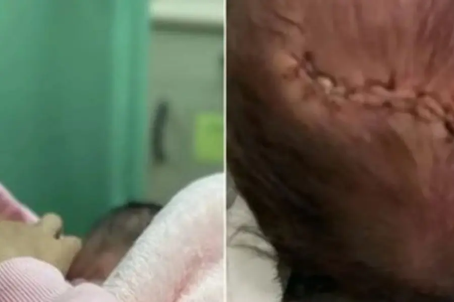 Una bebá cayó de cabeza minutos después del parto y le tuvieron que hacerle once puntos
