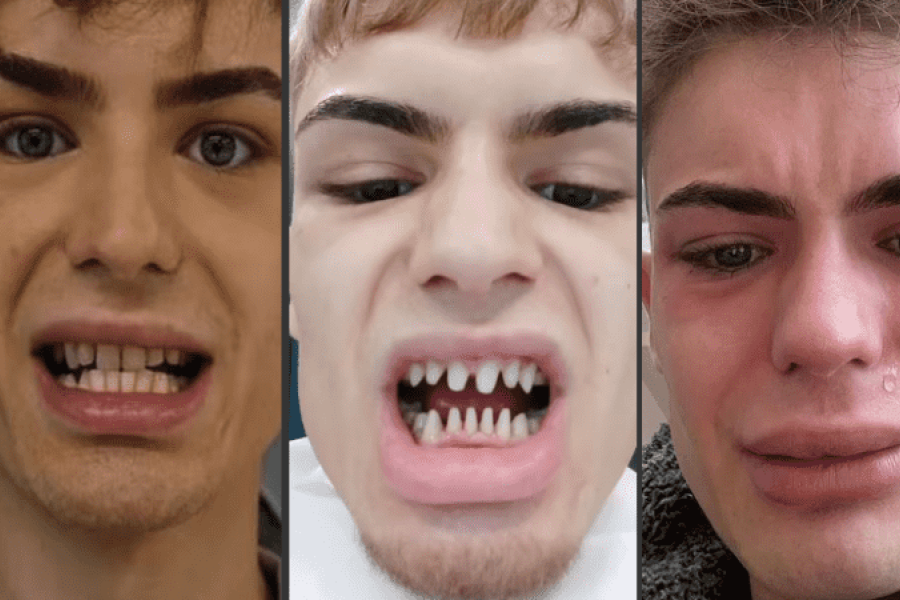 Modelo se sometió a intervención dental para mejorar su sonrisa y terminó "con dientes de tiburón"