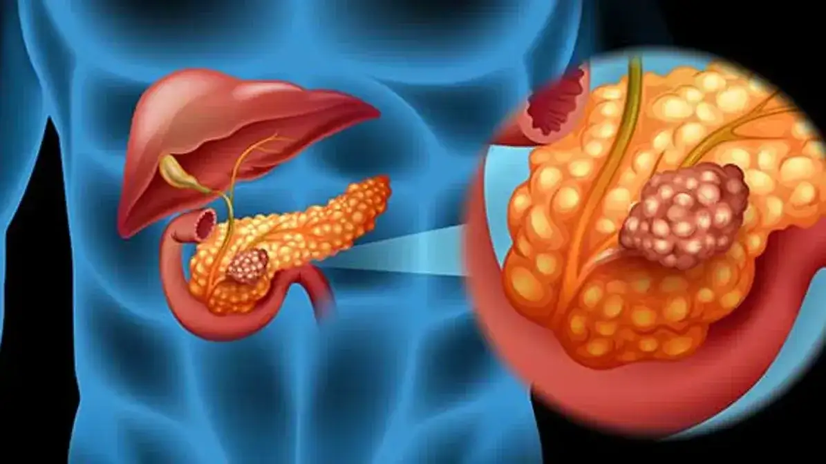 Cáncer de páncreas: científicos españoles lograron eliminar tumores en ratones