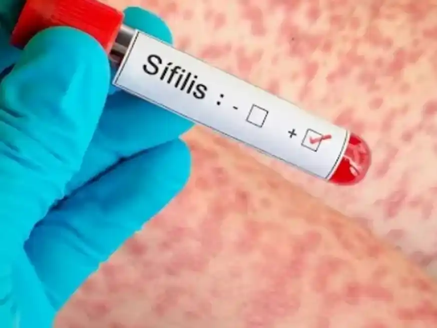 Alerta por sífilis en Argentina: aumento de reinfecciones en hombres. Gentileza