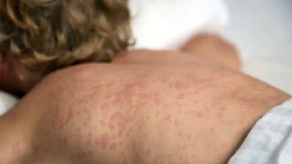 Enfermedades que ya no están y cómo las vacunas las frenaron