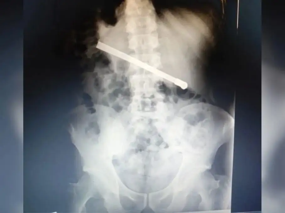 La impactante imagen de la placa radiográfica del interno de la cárcel.