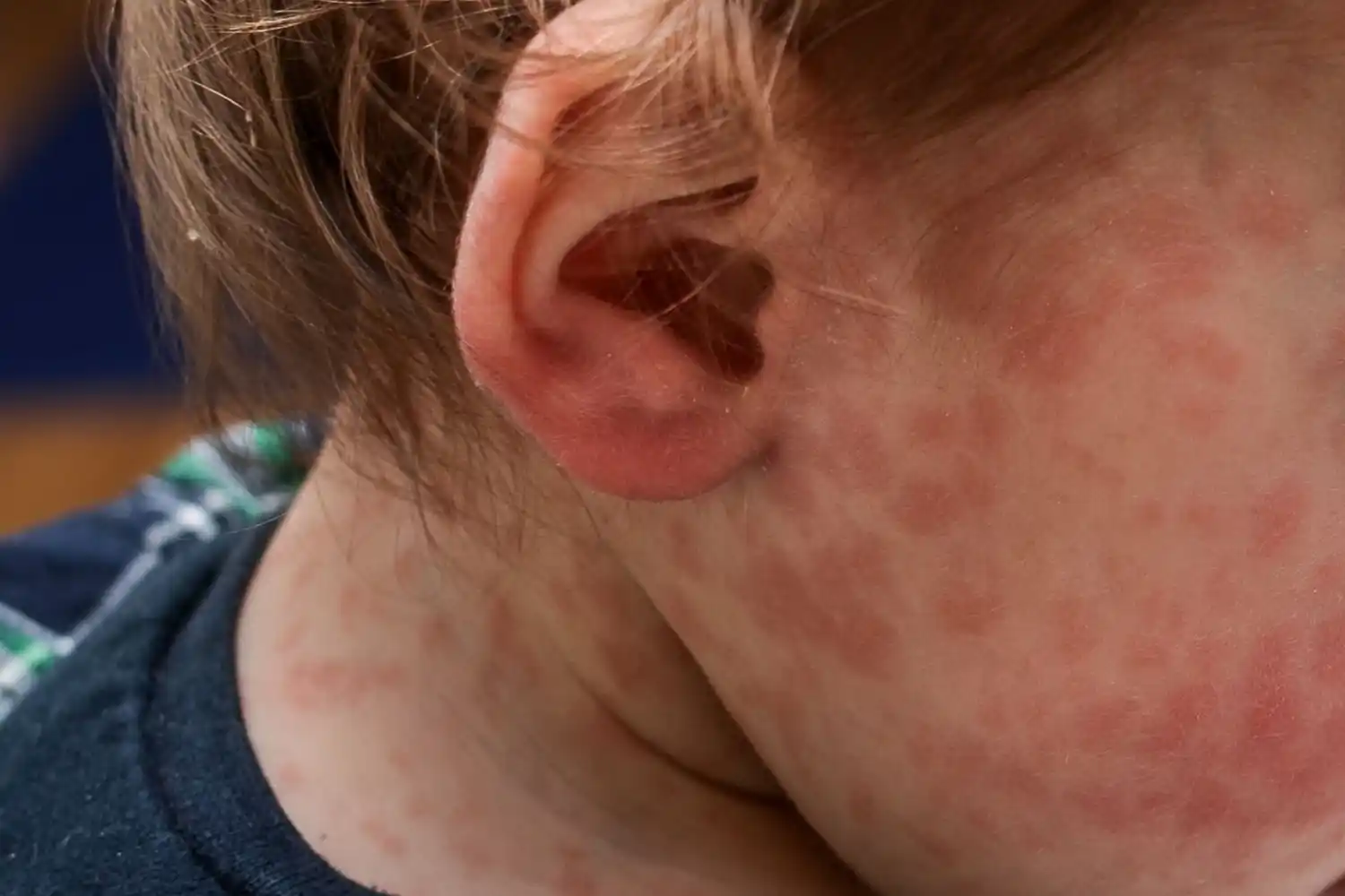 Ante la confirmación de un caso de sarampión, Salud convocó a comisión de vigilancia