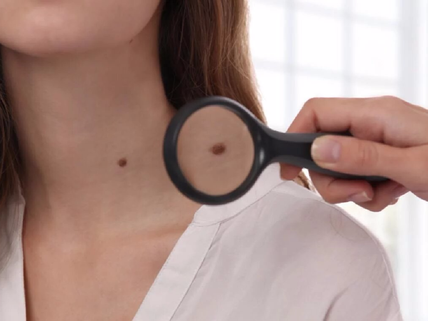 Realizarán controles gratuitos para prevenir el cáncer de piel