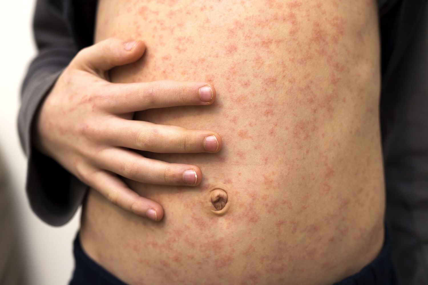 Emitieron un alerta de sarampión ¿Qué medidas tomar para prevenir?