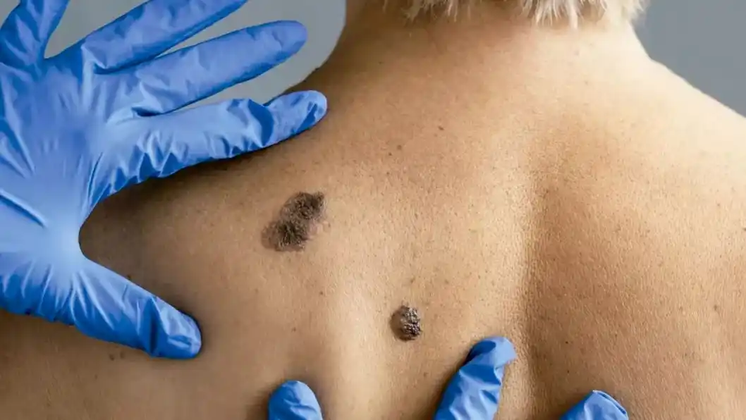 camas solares cancer de piel - 3