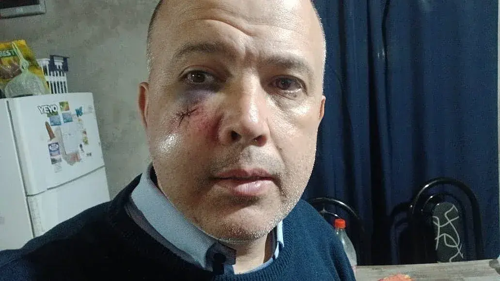 Luis Romero sufrió una triple fractura en su rostro.