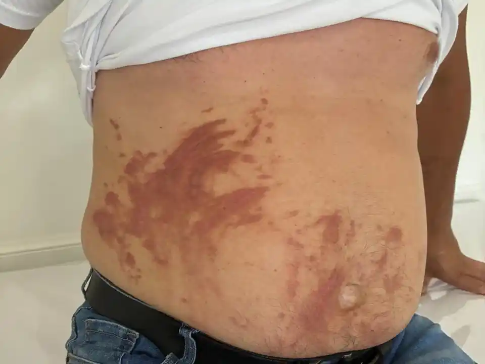 Picaduras y reacciones alérgicas: la advertencia de una dermatóloga en pleno verano