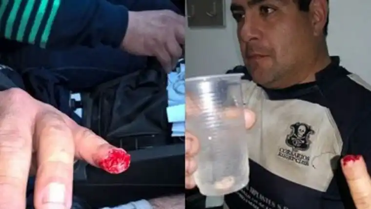 Un rugbier mordió a otro en pleno partido y le arrancó un dedo