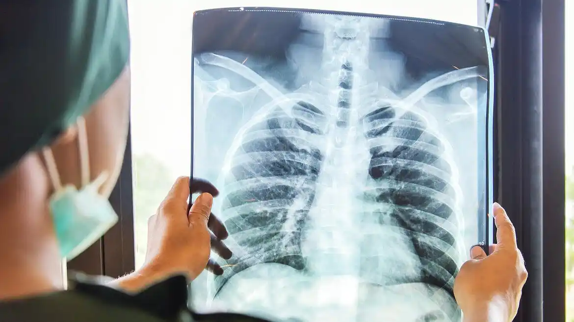 Día Mundial del Cáncer de Pulmón: causas y prevención
