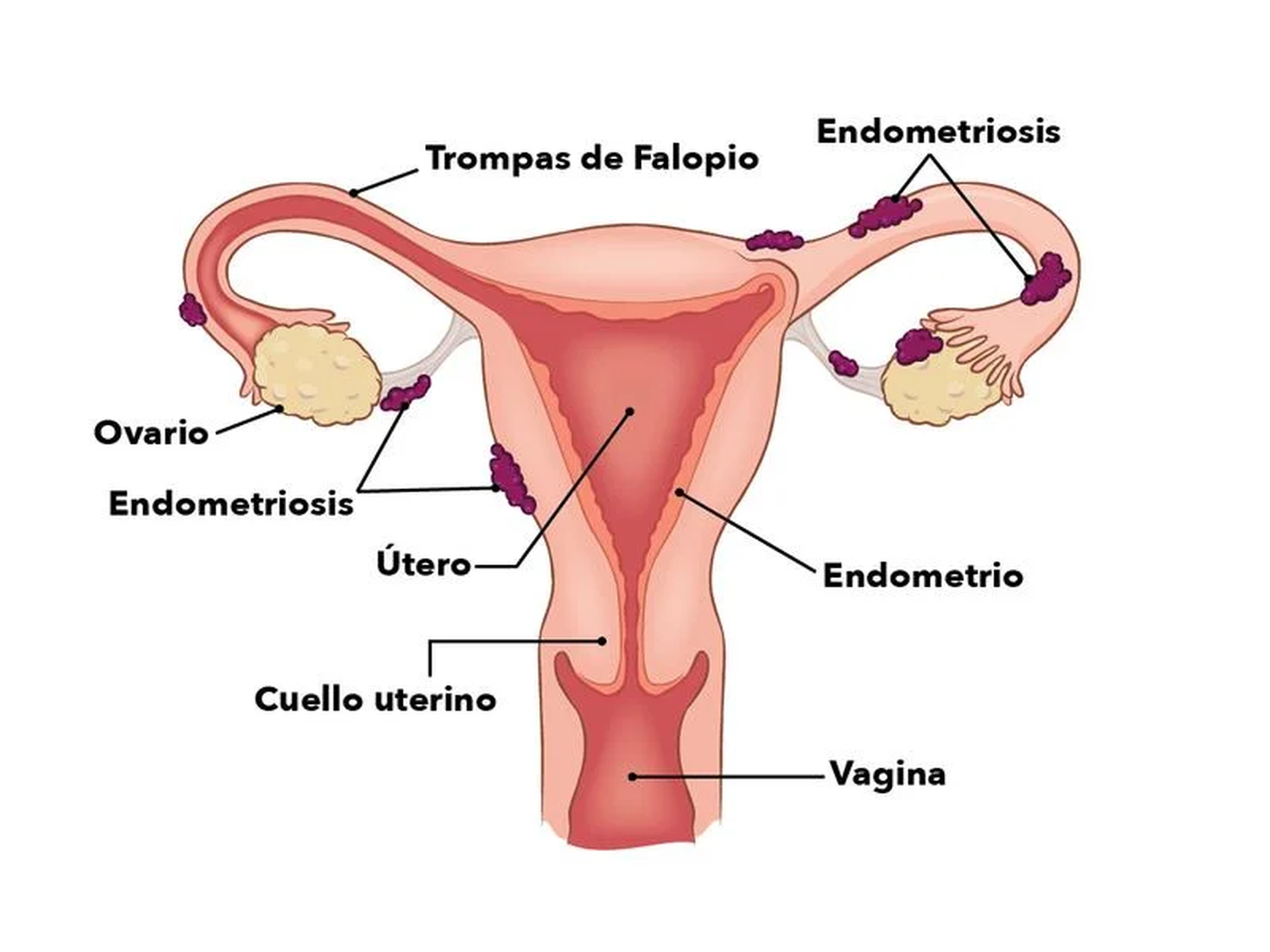 14 de marzo, Día Mundial de la Endometriosis: una enfermedad silenciosa que afecta a millones de mujeres