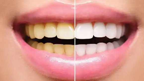 Cinco recomendaciones para unos dientes blancos y sanos