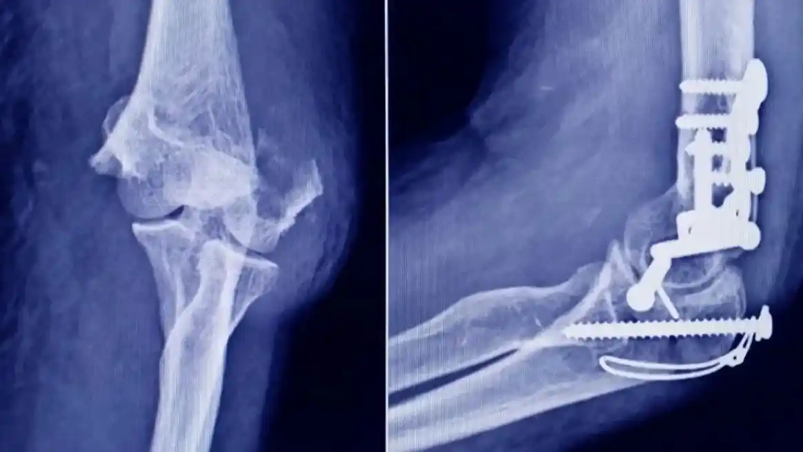 ANMAT prohibió insumos traumatológicos por falsificación y falta de control sanitario