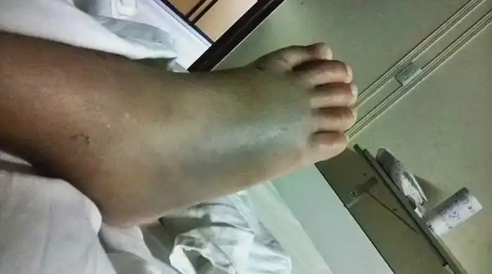 Bahía Blanca: Nene de 5 años mordido por una yarará