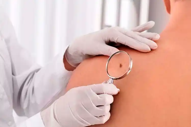 Campaña gratuita de control de lunares en Lalcec