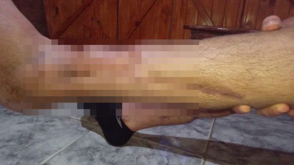 Lleva dos años sin caminar y necesita una prótesis que vale más de 2 millones de pesos: “La estoy pasando mal”