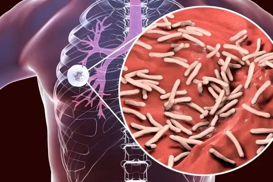 tuberculosis